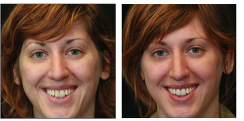 Veneers and Cosmetic Dentistry from Boston Dentist Dr. Jill Smith