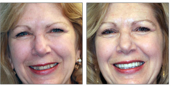 Age Defying Dentalift from Boston Dentist Dr. Jill Smith.