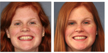 Adult Orthodontics, Invisalign from Boston dentist Dr. Jill Smith