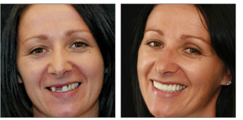 Complex Dental Reconstruction from Boston dentist Dr. Jill Smith