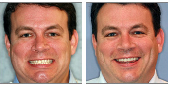 Veneers and Tooth Whitening from Boston dentist Dr. Jill Smith